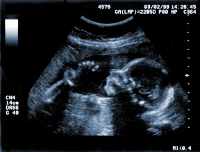Sonogram 2D Full Baby image